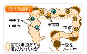 腸内洗浄のやり方